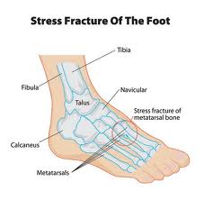 stress fracture of foot